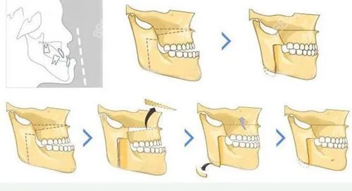 骨性地包天矯正手術風險大嗎從地包天做正頜手術過程瞭解