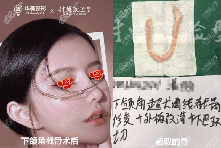 看著很man手術過程:下頜角超長曲線截骨修復 外板改薄 下巴環切術後