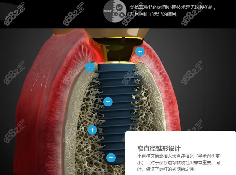 韓國美格真和奧齒泰種植體哪個好?我牙槽骨薄要選誰合適