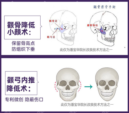 颧骨内推示意图图片