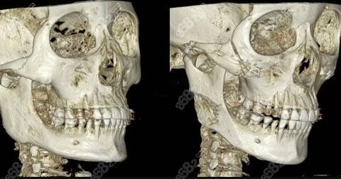 首頁 對比照片 頜面對比照 正文顴骨內推手術適合顴骨高寬的人,下頜角