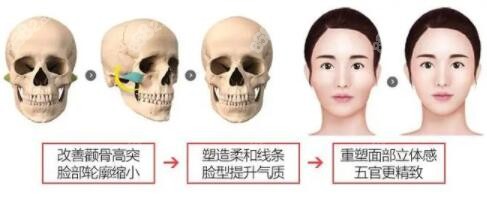 做了顴骨內推後悔了難道是因為顴骨內推後皮膚下垂了