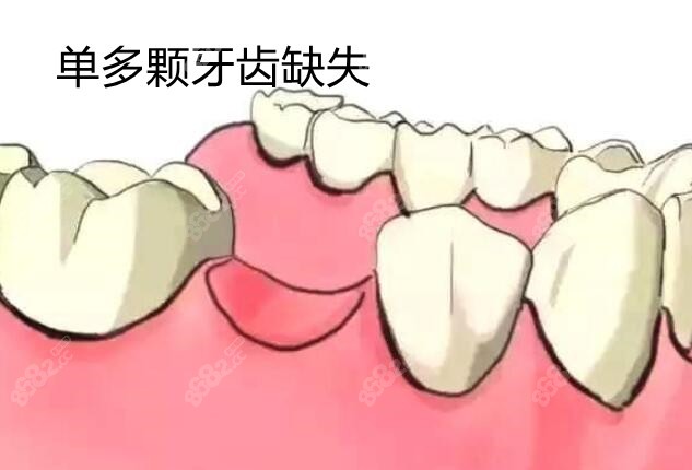 單多顆牙齒缺失