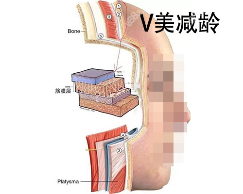 北京加减美面部v6提升