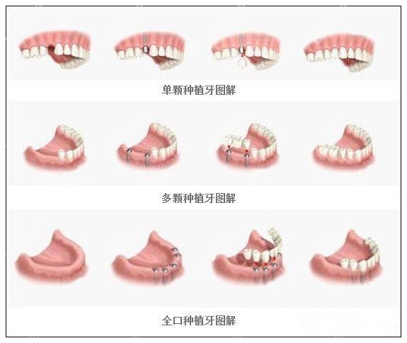 南通全口种植牙价钱可参考南通这几家种牙便宜又好的医院,牙齿对比