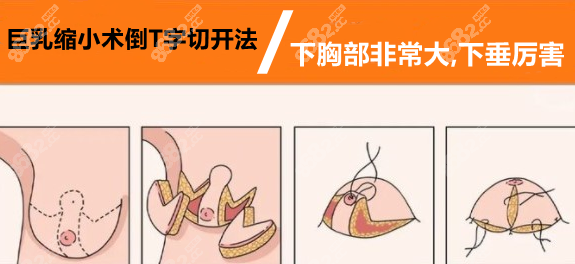 正文適用人群:乳房肥大,不下垂,肥大原因不僅僅因為脂肪,還有乳腺