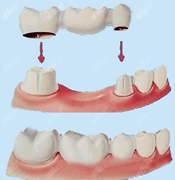 活动假牙和固定假牙哪个比较好看了牙槽骨萎缩情况后再说