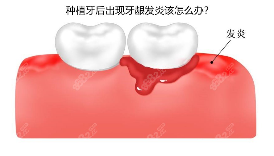 种植牙后牙龈发炎图片图片