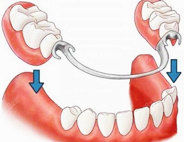 活动假牙和固定假牙哪个比较好看了牙槽骨萎缩情况后再说
