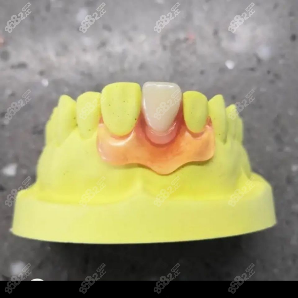 一颗门牙隐形义齿图片图片