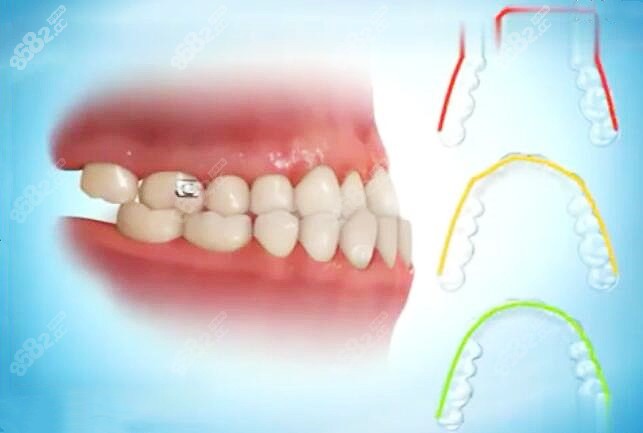 孝感矯正牙齒靠譜的口腔醫院分享地包天隱形矯正要多少錢