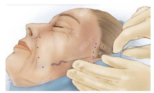 人工韧带面部提升手术过程