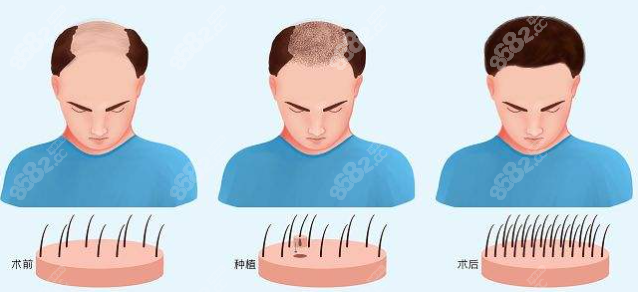 毛发种植过程展示图