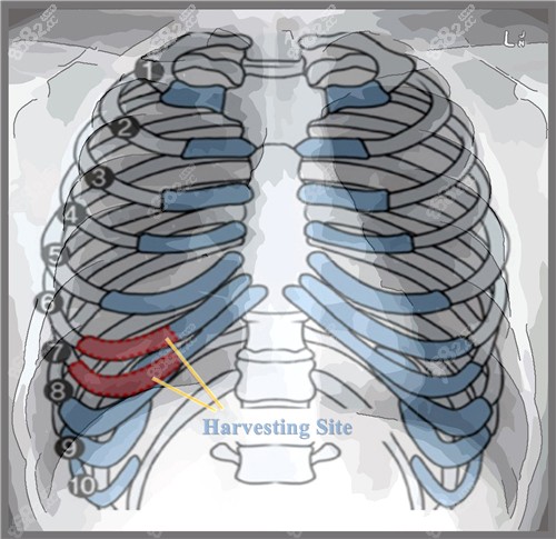 取肋骨位置示意圖