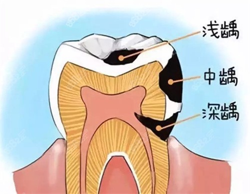 北京口腔醫院補牙示意圖