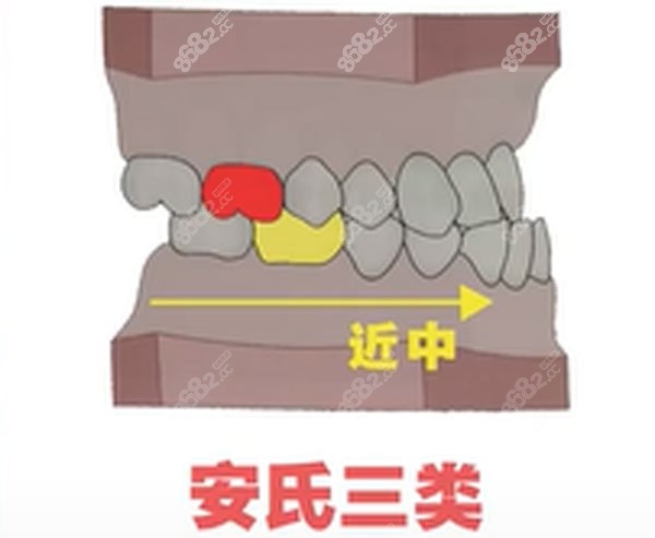 一,正畸骨性一類二類三類分別指什麼?