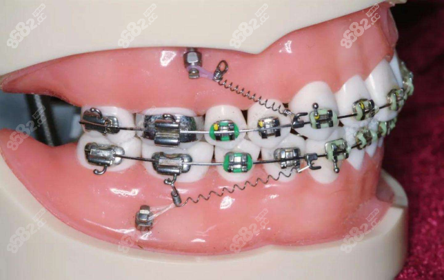 扭转牙的正畸过程图解图片
