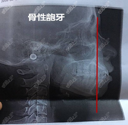 骨性齙牙和牙性齙牙怎麼區分有牙性和骨性齙牙對比照嗎