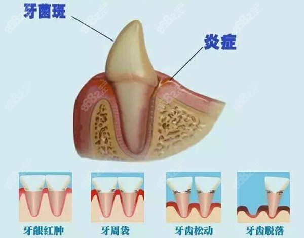 重度牙周炎導致牙齦萎縮