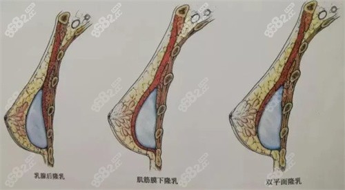 雙平面隆胸示意圖