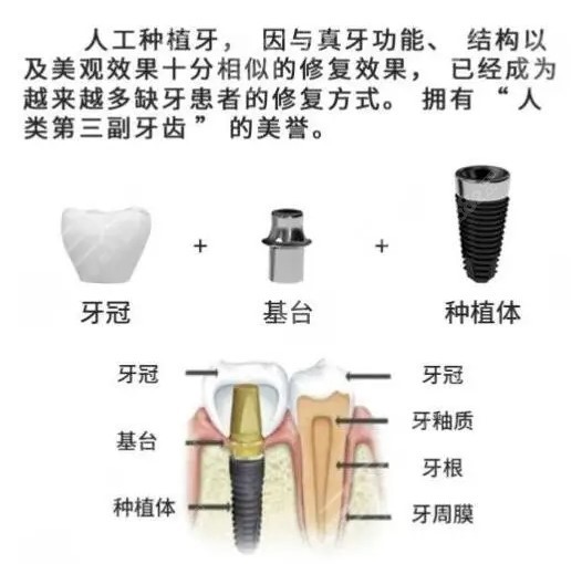 北京瑞泰口腔种植牙价格多少钱韩国dio种植牙才5900元起