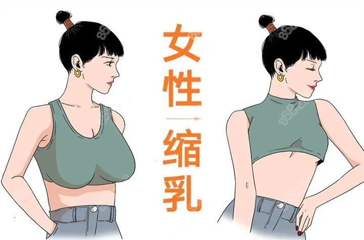 乳房悬吊术对比图片