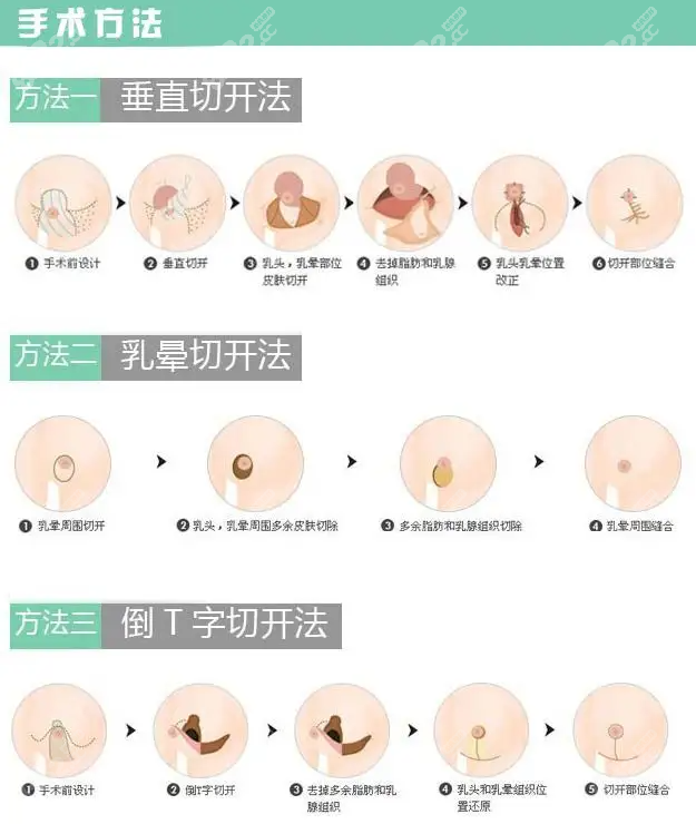 西安縮胸手術哪個醫院好西京國際乳房縮小做得好費用不高