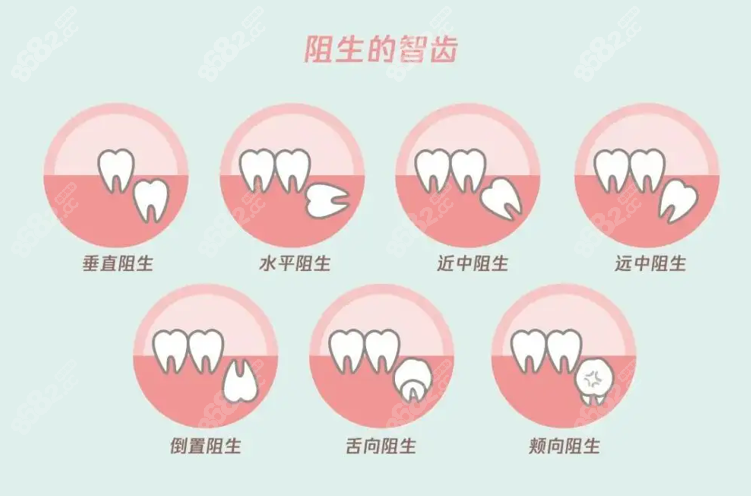 在北京拔阻生智齿1500元合理吗拔智齿能报销吗