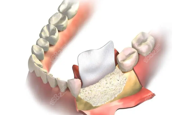 牙槽骨吸收了还能种植牙吗可通过植骨粉骨膜修复来种牙哦