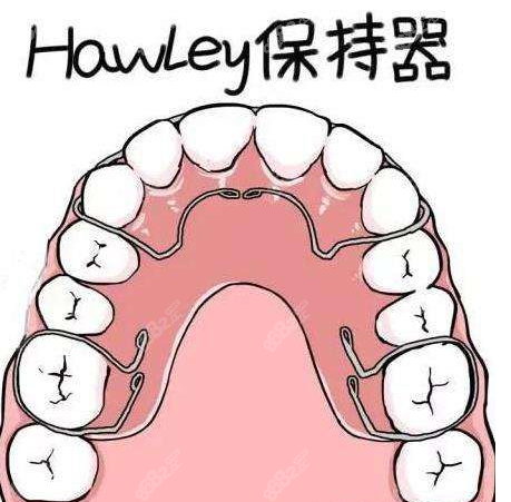 大盤點:哈利式hawleys保持器和透明隱形保持器的優缺點,牙齒對比照片-