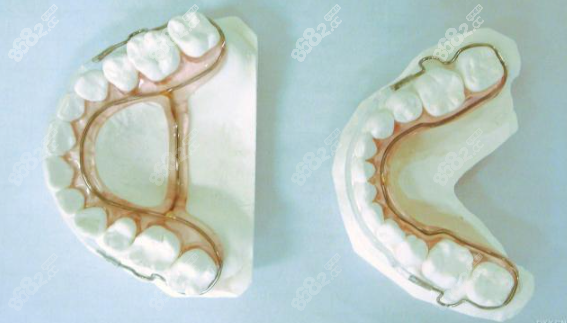 腭弓式间隙保持器图片