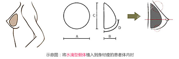 廣州曙光的隆胸實例都說劉傑偉雙平面豐胸技術是真的好