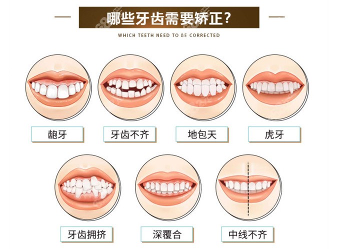 深覆合,齙牙等牙齒情況都可以通過牙齒矯正進行改善