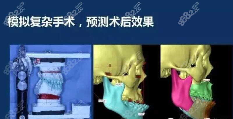 成都華西正頜手術好的醫生技術比拼李繼華和羅恩正頜誰好