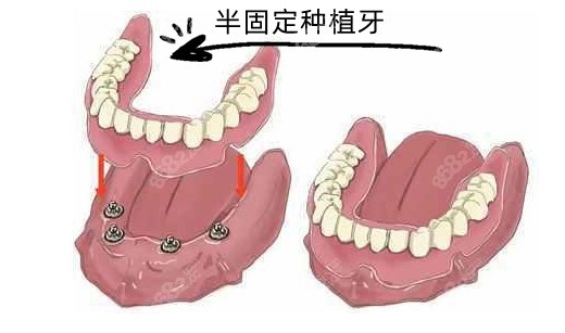 cc1,全口普通活動義齒價格:2000-10000元起①鈷鉻合支架金活動義齒